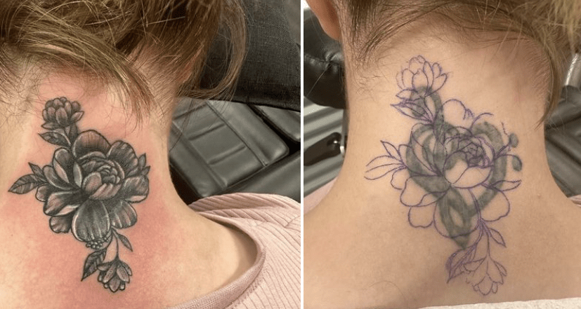 Tattoo Removal For Cover Up Tattoos